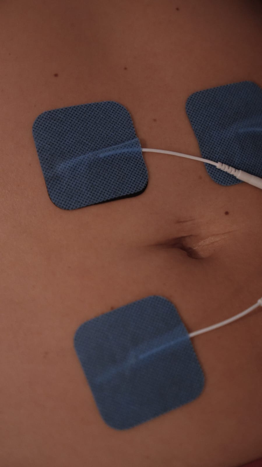 Eletroestimulação abdominal (EletroBody) aplicada em atendimento de estética corporal em Goiânia